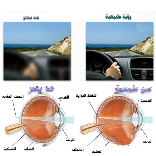مد البصر Hyperopia