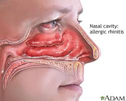 حساسية الأنف Allergic Rhinitis صحيفة روناهي