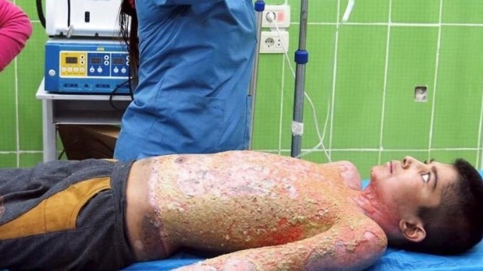 صرخات محمد الذي أصابه الفوسفور التركي تشبه صرخات طفلة فيتنامية أصيبت بالنابالم