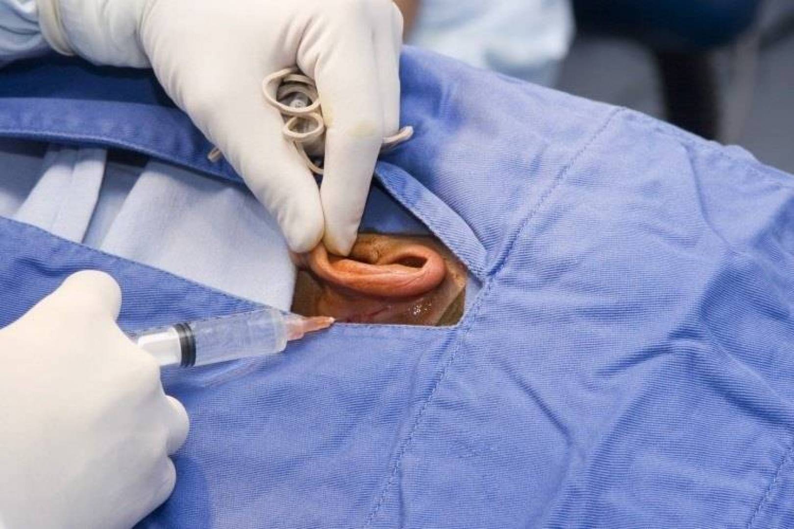 لعلاج صِغر الأذن… عملية زرع مبتكرة باستخدام خلايا بشرية وطابعة ثلاثية الأبعاد