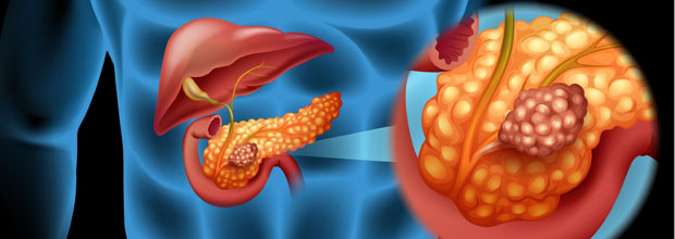 مادة مشعة تُزرع داخل الورم للقضاء على سرطان البنكرياس