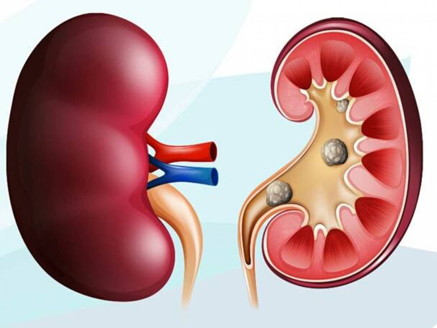 أطعمة ومشروبات للوقاية من حصوات الكلى