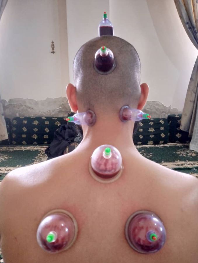 الحجامة.. أبرز وسائل الطب البديل المنتشرة في شمال وشرق سوريا