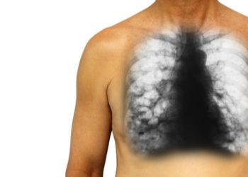 التهاب القصبات…. الأعراض والأسباب وطُرق العلاج