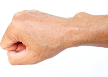 الكيس الدهني.. الأسباب والأعراض والعلاج